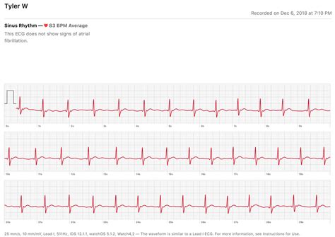 This Is What An Apple Watch Ecg Looks Like Ecg