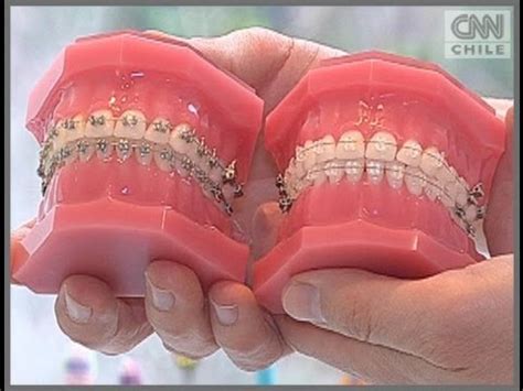 frenillos de zafiro nueva tendencia en la salud dental