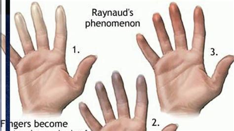 Raynauds Disease Symptoms Causes And Treatments Faculty Of Medicine