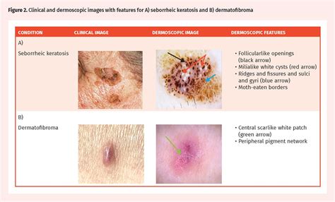 Differentiating Malignant Melanoma From Other Lesions Using Dermoscopy The College Of Family