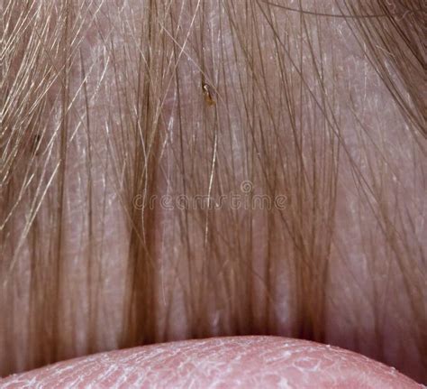 Lice Stock Photo Image Of Eggs Skin Hair Dandruff 23263424