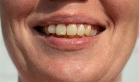 What You Should Know About White Spots On Your Teeth