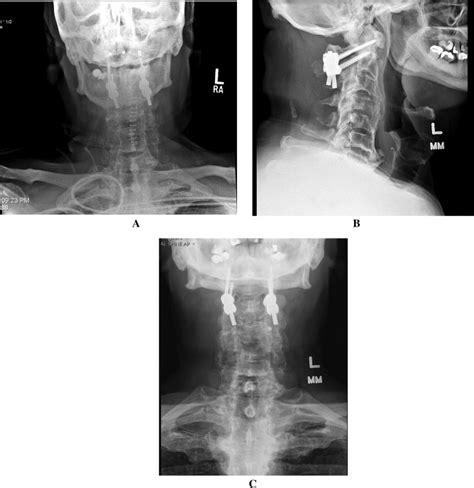 Occipital Neuralgia A Neurosurgical Perspective Journal Of Clinical