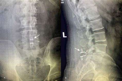 Cureus Lumbar Facet Joint Cyst Treated With Decompression And