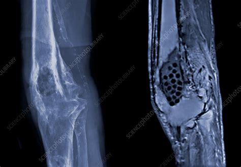 Osteomyelitis Knee X Raymri Stock Image C0094692 Science Photo