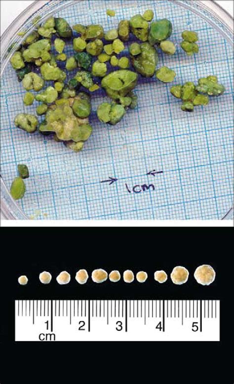 Could These Be Gallstones The Lancet