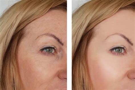 Refining Tear Troughs With Juvederm Health Supplies Plus