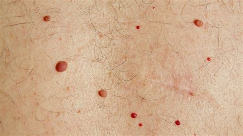 What Does Skin Cancer Really Look Like Skin Cancers Sharecare