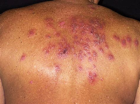 Is It Shingles 7 Myths About Painful Illness Graphic Images Cbs News