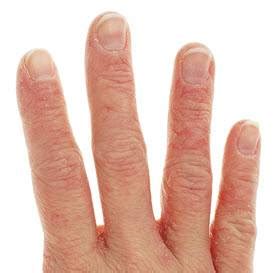 Eczema Between Fingers Dorothee Padraig South West Skin Health Care