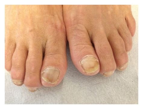 Discoloration And Onycholysis Image In Bilateral Toenail Download