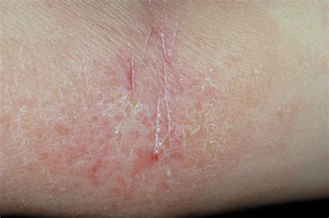 Atopic Eczema In A Child Photograph By Dr P Marazziscience Photo Library