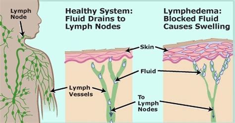 Lymph nodes (hodi lymphatici) are the most numerous organs of the immune system, they serve as biological filters for the lymph (tissue fluid) flowing through them. 7 Easy Ways To Quickly Unclog Your Lymph Nodes To Reduce ...