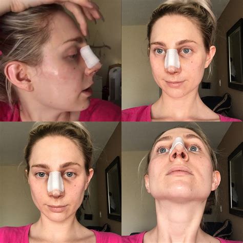 Nose Job Surgery Recovery Cast Removal Two Week Post Op Reveal Rhinoplasty It Cast