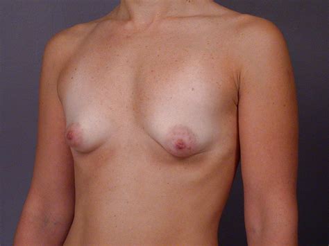 Lopsided Boobs And Asymmetrical Tits 69 Pics Xhamster