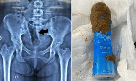 a pelvic radiograph revealed a well defined radiolucent structure in download scientific