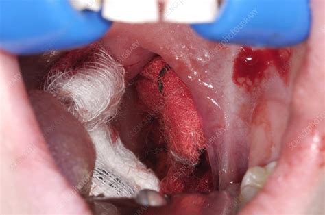 Tonsillectomy Stock Image M5720051 Science Photo Library