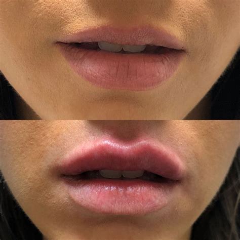 Lip Injections Before And After In 2020 Lip Injections Juvederm Lips