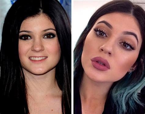kylie jenner lip fillers before and after