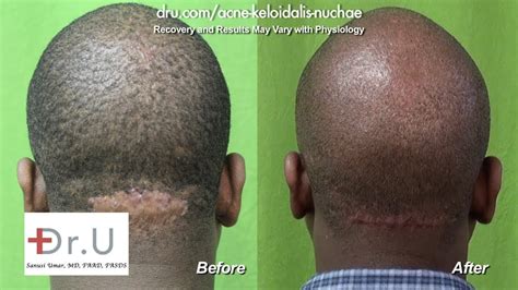 Hair Bumps On Head Removal Best Haircuts In Vrogue Co