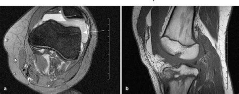 Lipohemarthrosis Of The Knee Mri As An Alternative To The Puncture Of