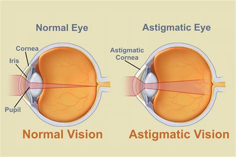 Astigmatism Surgery Options Astigmatism Glaucoma Swollen Eyes Disease