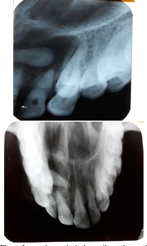 Figure I From Dentigerous Cyst Of Maxilla Associated With Impacted