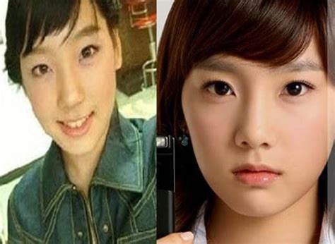 Taeyeon Singer Before And After Plastic Surgery