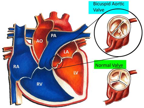 Aortic Valve Disease Causes Symptoms Exercises And