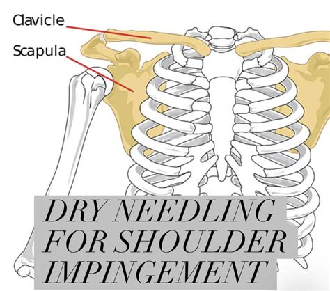 Dry Needling For Shoulder Impingement Access Health Chiropractic Center