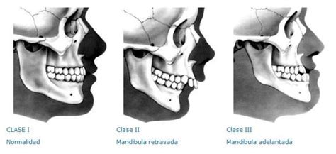 Alternativas De Tratamiento Interceptivo Para Pacientes Clase Iii Por