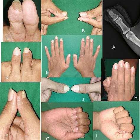Allens Classification Of Fingertip Injuries 1 Type I Loss Of Only