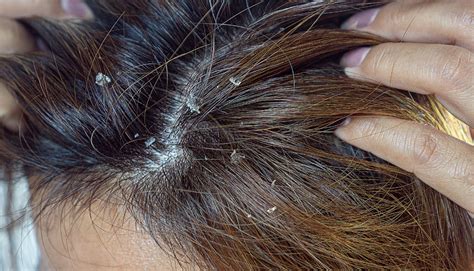 Mild Seborrheic Dermatitis Scalp