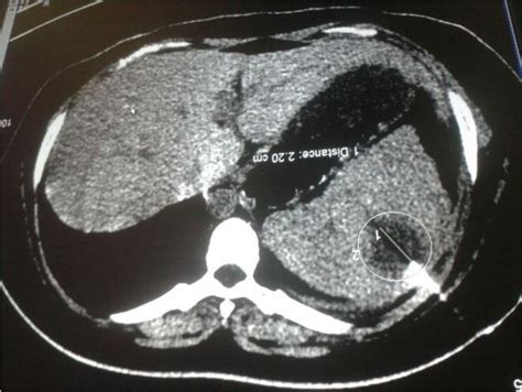 Ct Scan Of Abdomen Showing Enlarged Spleen With A Large Solitary