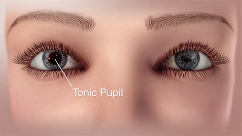 Tonic Pupil Syndrome Illustrated Using A 3d Medical Animation