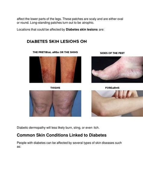 Ppt Diabetic Dermopathy And How To Save Our Skin From It Powerpoint