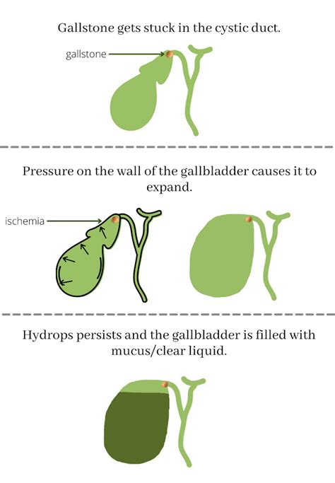 Cureus Gallbladder Hydrops