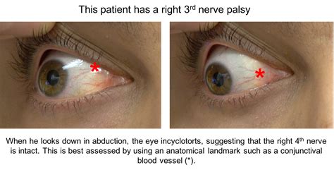 Trochlear Nerve Palsy Eye Position