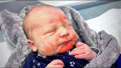 Rashes On Face In Newborn Babies Newborn Baby