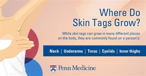 The Skinny On Skin Tags 6 Questions And Answers Penn Medicine