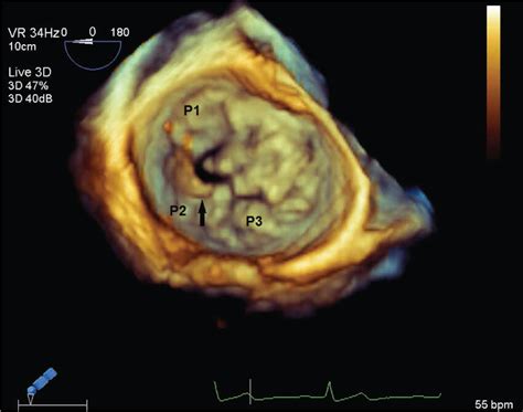 The Flail Of The Mitral Posterior Middle Scallop On 3 Dimensional
