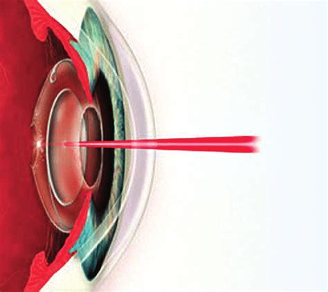 Yag Laser Treatment On Secondary Cataract Download Scientific Diagram