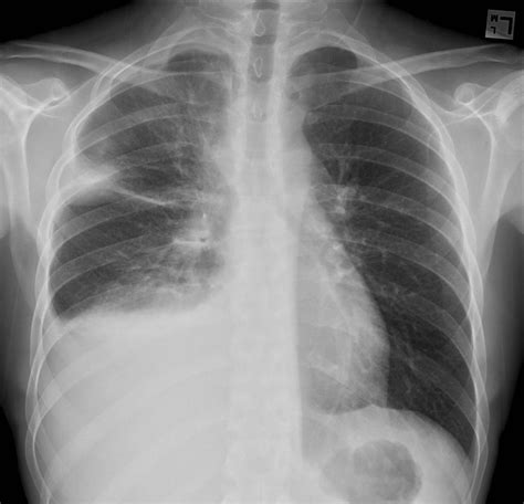Non Hodgkin Lymphoma Chest X Ray Wikidoc