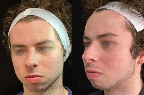 Chemical Peels Before And After Photo Gallery Natick Ma Essential Dermatology