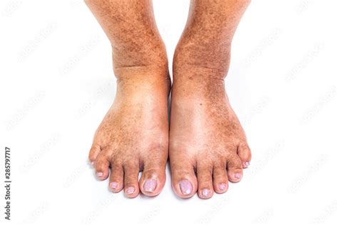 Closeup Skin At Legs Show Mottled Skin Caused By Diabetes Stock Photo
