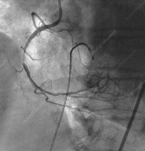 Heart Angiogram Before Stent 1 Of 2 Stock Image C0272796 Science