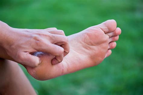 How To Alleviate The Symptoms Of Eczema On The Feet Walkrite Foot Clinic