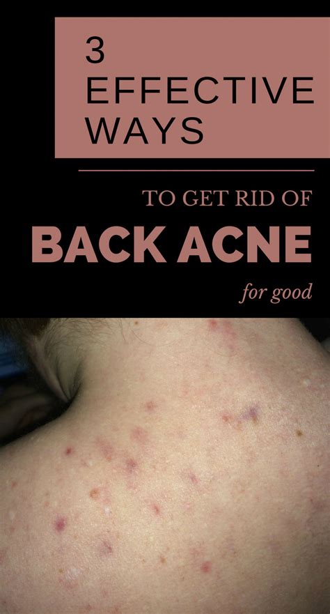 Acne And Also Pimples Remedies Natural Means To Eliminate And Avoid