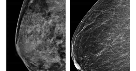 No Clear Answers With Mammograms And Dense Breasts