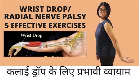 5 Effective Exercises For Wrist Drop Radial Nerve Palsy कलाई ड्रॉप
